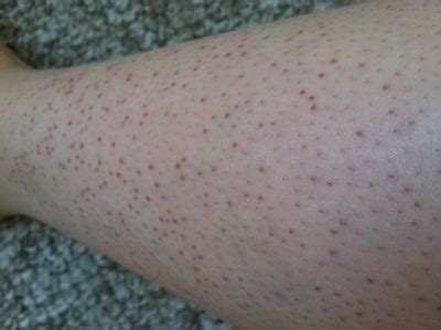 And then there's razor burn, which is like a super raw rash. Bright Red Spots After Hair Removal Treatment? (photo ...