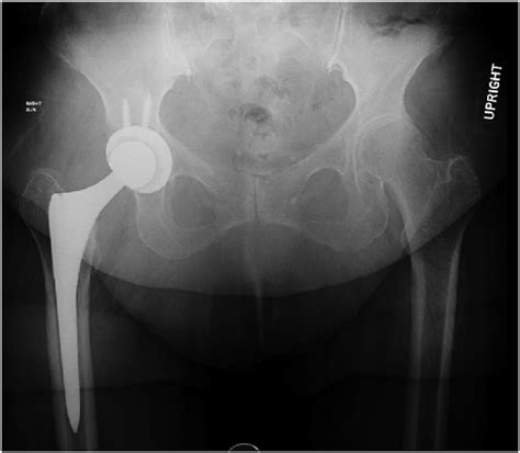 Preoperative Anteroposterior Ap Radiograph Of The Pelvis Revealing