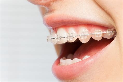 Why Clear Braces For Teens Are Recommended Uc Smiles Orthodontics San