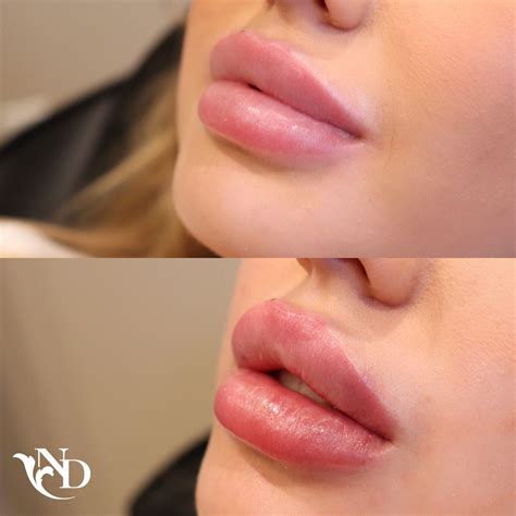 Lip Filler Before After Facial Fillers Lip Fillers Botox Lips