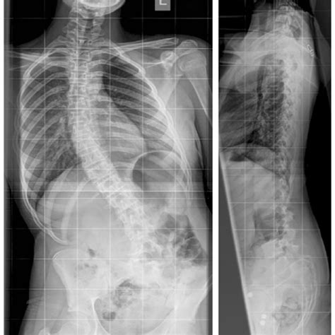 Standing Ap And Lateral Radiographs Showing Resolution Of The Scoliosis
