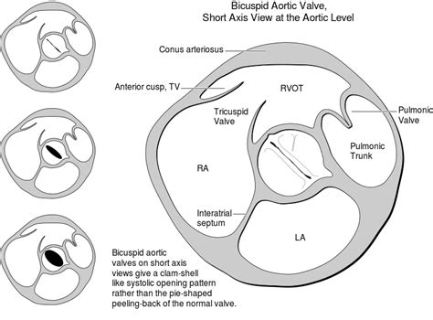 Heart Bicuspid Aortic Valve Anatomy Bicuspid Aortic Valve
