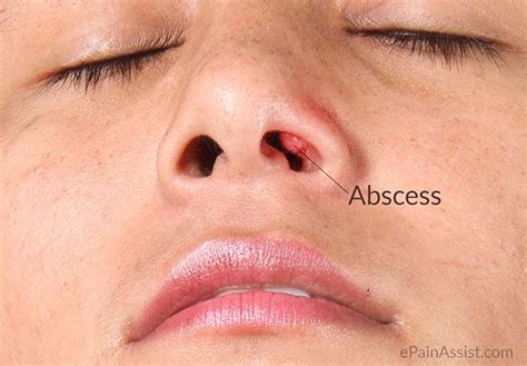 Nasal Vestibulitis Read Face Mouth Throat
