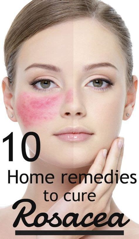 Rosacea Is A Chronic Skin Condition That Usually Affects The Face