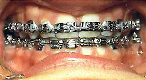 Old School Braces 1970s Dental Braces Orthodontics Braces Teeth Jewelry