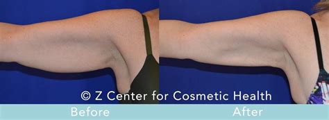 Arms Coolsculpting Before And After Gallery Z Cosmetic Health
