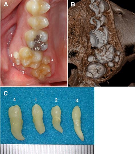 Case Of Supernumerary Teeth In Non Syndromic Patient