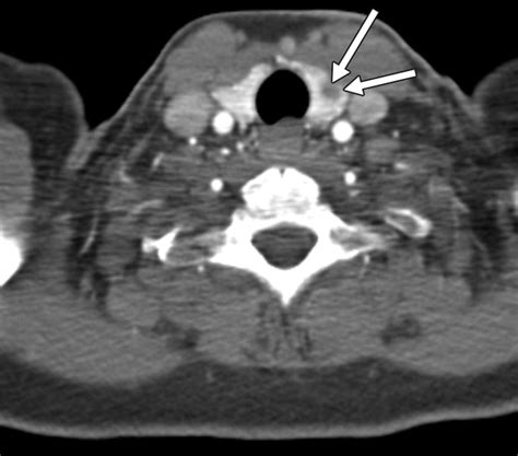Incidental Thyroid Nodules On Chest Ct Review Of The Literature And