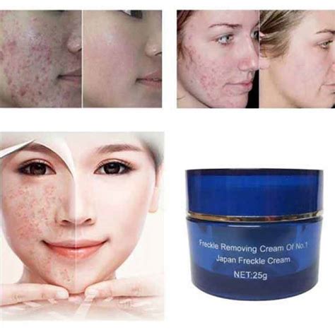 Anti Freckle Spot Removing Cream 25 Gm