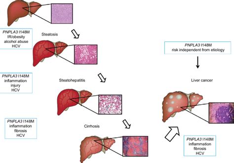Liver Disease Progression