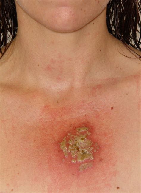 This may be any new growth on the skin, a sore that doesn't heal, or a change in an old growth. Cansema / CanSupport Testimonials for 2007-2009 - Alpha ...