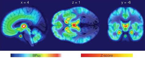 Borderline Personality Disorder A Dysregulation Of The Endogenous