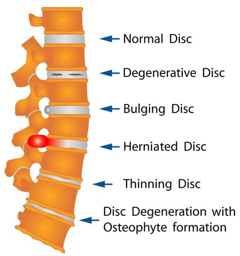 Herniated Disc The Spine Hospital At The Neurological Institute Of