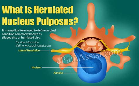Mengenal Penyakit Syaraf Kejepit Hernia Nucleus Pulposus Asalasah My
