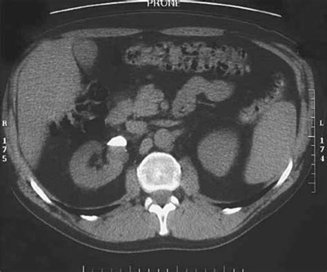 Prone Non Contrast Ct Scan Section Through The Kidneys Right Kidney