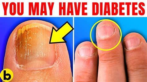 If You See This On Your Nails It Could Be A Tell Tale Sign Of Diabetes