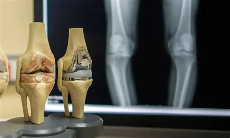 Signs You Need A Potential Knee Replacement Hot Sex Picture