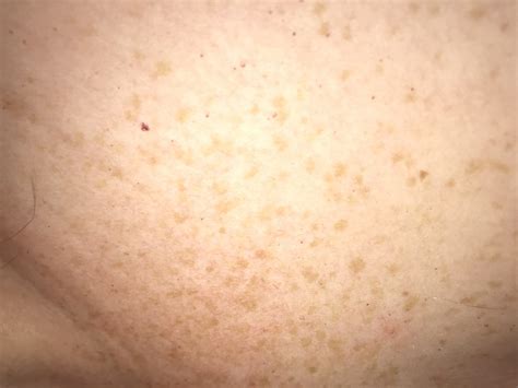 Pinpoint Red Dots On Skin Cancer Virttechs