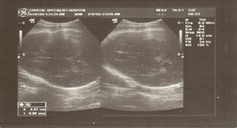 Transverse Sonogram Of The Fetal Calvarium At 30 Weeks Gestational Age