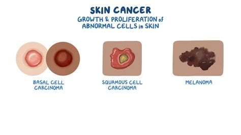 Skin Cancer Basal Cell Carcinoma Squamous Cell Carcinoma And