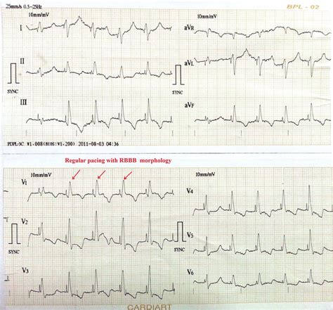 Ecg Showing Pacemaker Spike With Regular Capture And Pacing With Right