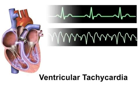 Ventricular Tachycardia Causes Symptoms And Treatment 2024