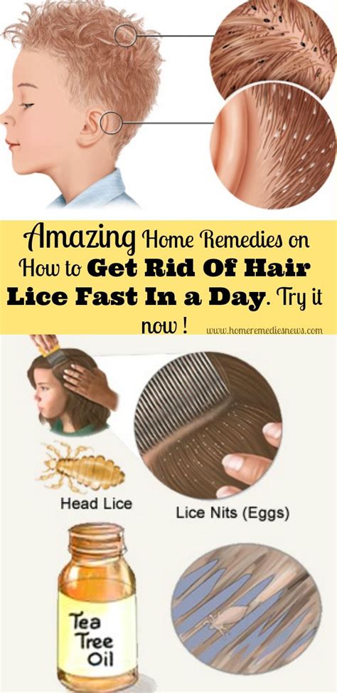 Get Rid Head Lice Home Remedies