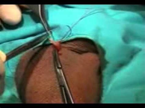 Inicio » procedimientos médicos » vasectomia: Hemorroidectomia por grampeamento | Doovi