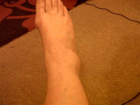Broken Ankle Symptoms Recovery Time Pictures Surgery Treatment