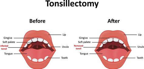 Infected Tonsil Adenoids And Tonsils Enlarged Tonsils