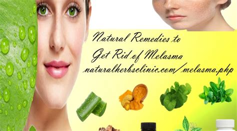 7 Natural Remedies To Get Rid Of Melasma Dubai Entertainment
