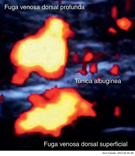 Tunica albuginea and buck fascia. Fuga venosa dorsal profunda como causa de disfunción ...