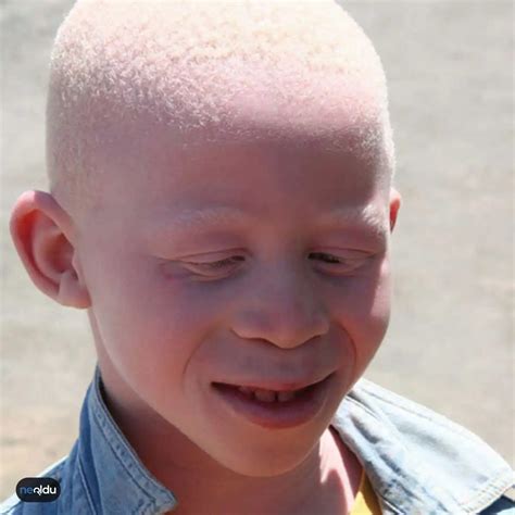 Albinizm Nedir Belirtileri Nelerdir Ve Tedavisi Var M