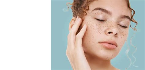 Best Freckle Removal Treatment In Delhi
