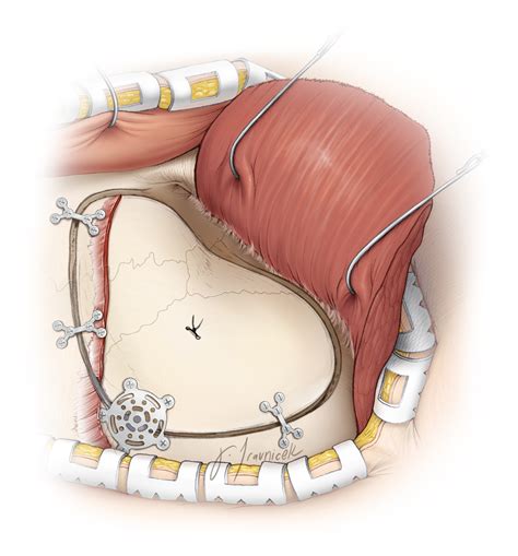 Pterional Craniotomy The Neurosurgical Atlas By Aaron Cohen Gadol Md