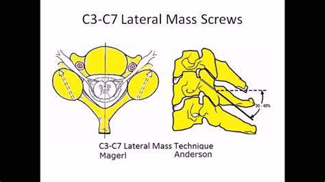 Lateral Mass Screws Movie And Lecture By Prof Mohamed Mohi Eldin Youtube
