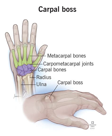 Carpal Boss What Is It Causes Symptoms Treatment