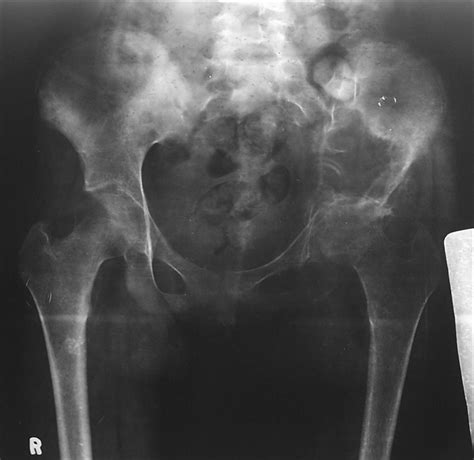 The macmillan cancer support website has more information about secondary bone cancer. GIANT CELL TUMOR HAND | buyxraysonline