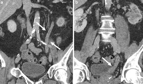 Ct Urogram Obtained During The Nephrographic Phase A B Demonstrated