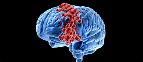 An Antibiotic May Stop Growth Of Deadly Brain Cancer Cancer
