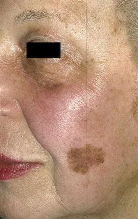 Skin Cancer On Face Pictures 33 Photos Images Illnessee Com