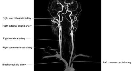 Radiology Anatomy Images Neck Ct Angiogram Anatomy