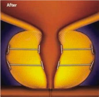 Bladder Neck Obstruction Treatments | Dr Katelaris ...
