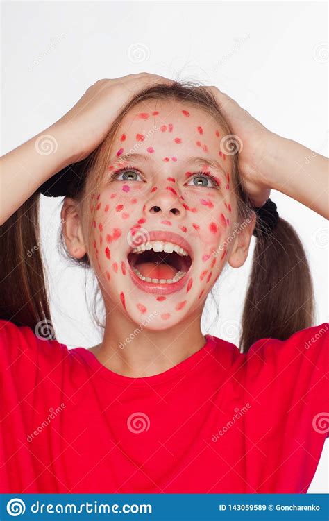 Front View Of A Girl With A Problem Skin Rash Stock Image Image Of