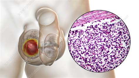 Testicular Cancer Illustration And Light Micrograph Stock Image F Science Photo