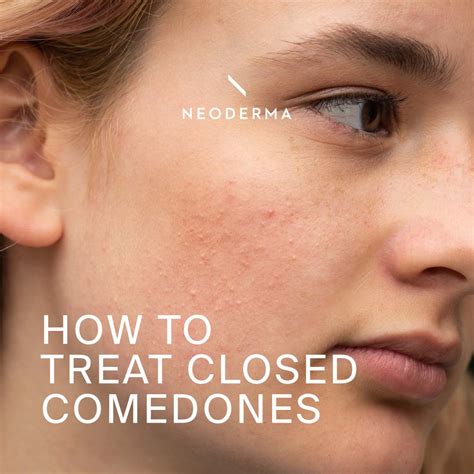 How To Treat Closed Comedones Neoderma