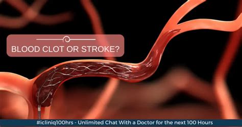 Can A High Platelet Count Cause A Blood Clot Or Stroke
