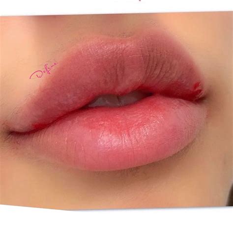 The Perfect Bow Shaped Lip Botox Lips Lips Inspiration Lip Surgery