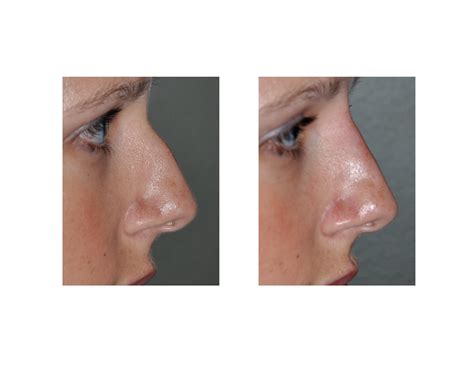 Injectable Rhinoplasty Result Dr Barry Eppley Indianapolis Explore