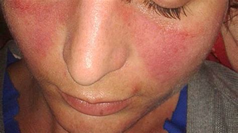 What Causes Redness And Itching On Face Allergy Differences